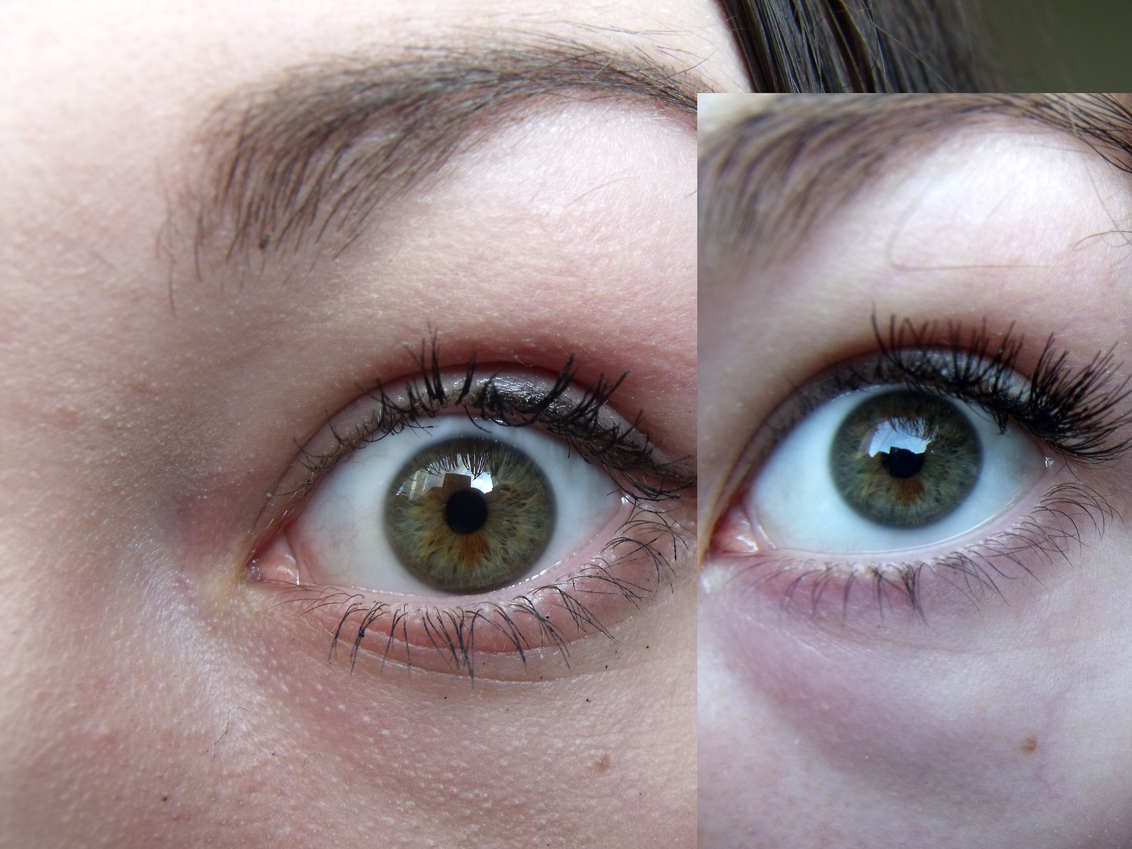 Осветление цвета глаз лазером. Обесцвечивание Радужки глаза. Осветление глаз до и после. Лазерная операция по изменению цвета глаз.